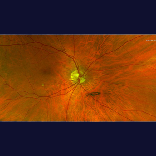 Ultra-Widefield Retinal Imaging